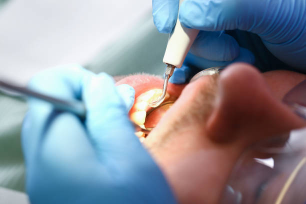 Best Emergency Root Canal Treatment in Fairbank, IA